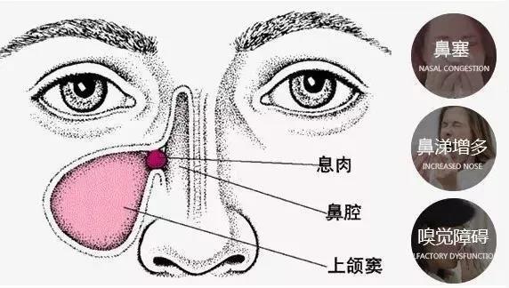 鼻息肉的三种类型