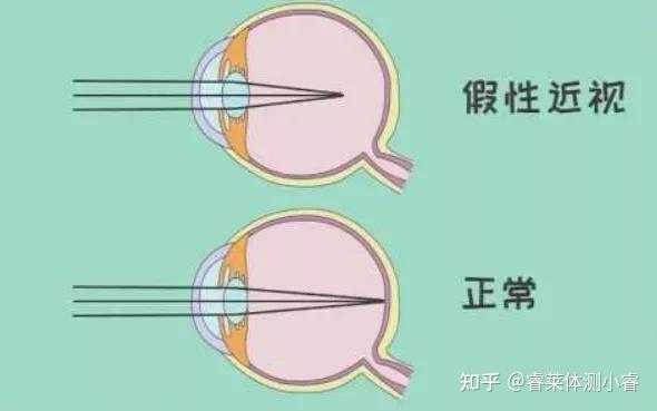 真性近视是指由于眼轴变得过长以后产生的屈光不正.