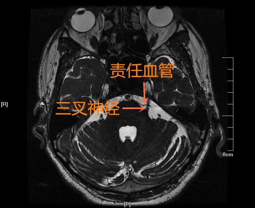 病例分享三叉神经痛左侧面颊部疼痛4年mvd术后疼痛消失重展笑颜