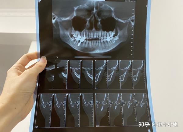 上颌智齿紧贴着上颌窦黏膜怎么办