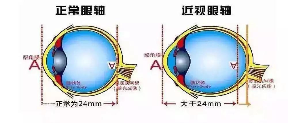 最火的3种近视手术对比你适合哪种