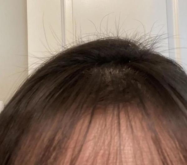 刚刚我经历了一场轰轰烈烈的产后脱发
