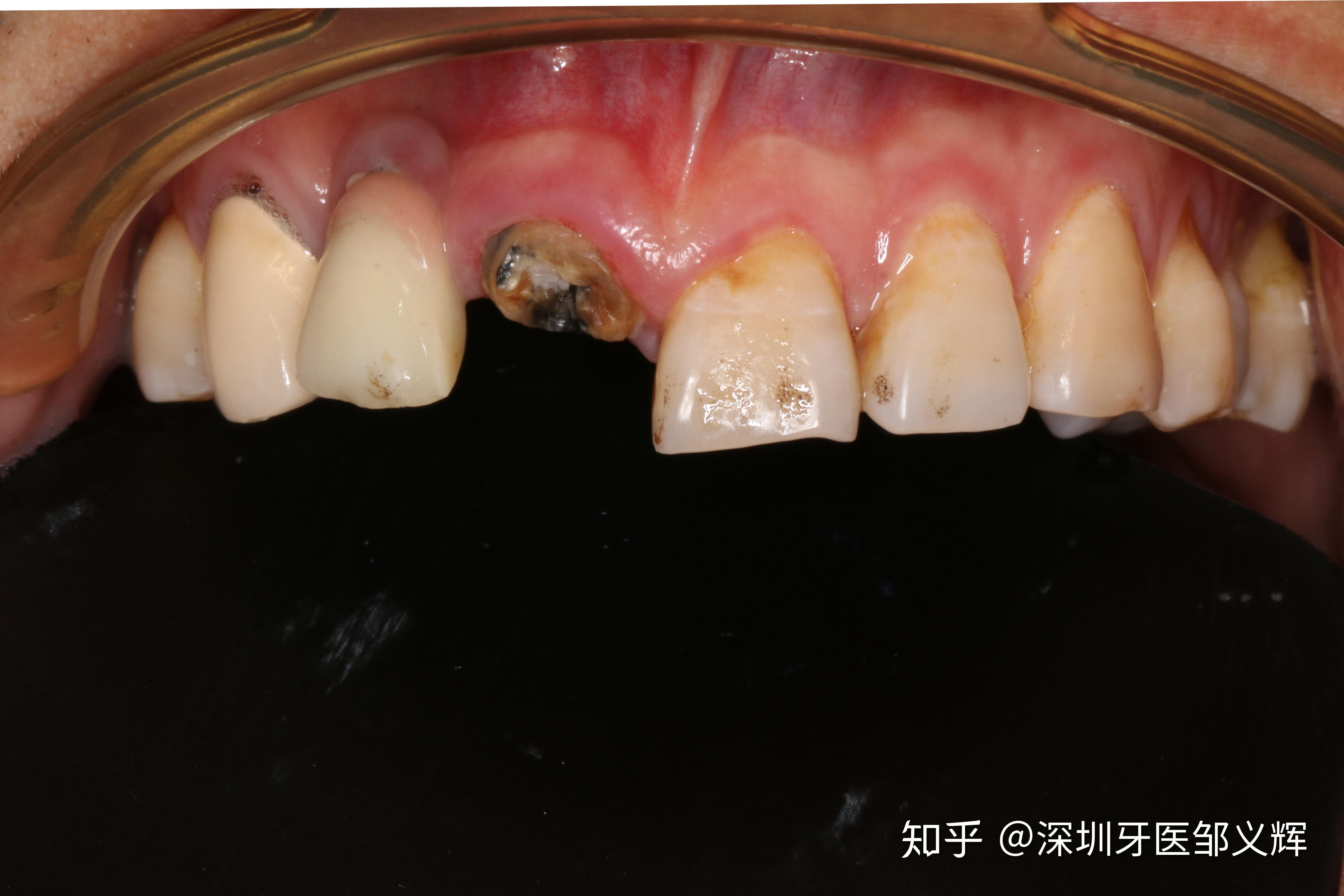 前牙折断氧化锆桩全瓷冠修复一例