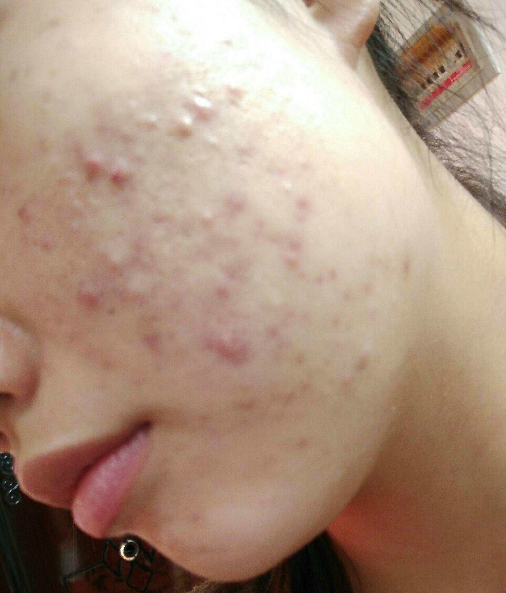痘痘