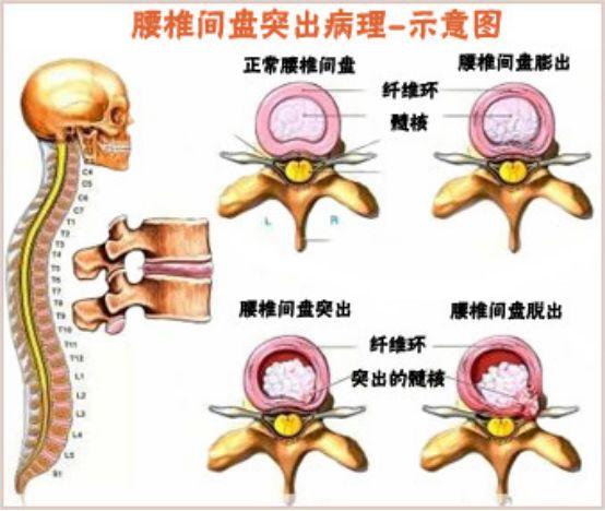 如何预防腰椎间盘突出?