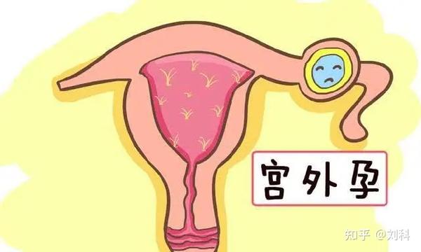 异位妊娠,也就是我们常说的"宫外孕"