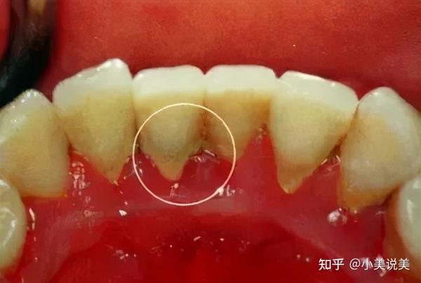 牙周炎会通过接吻传染吗