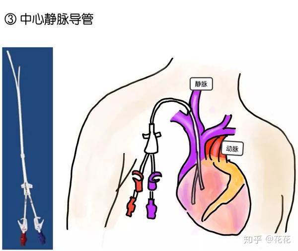 尿毒症透析?