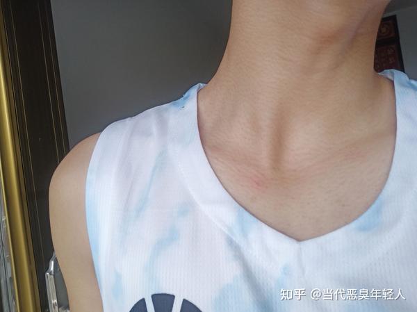 就锁骨和脖子那一片有一条条的条纹,有好久好久了,是怎么回事?