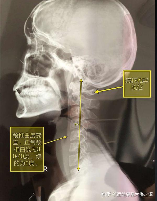 寰枢椎半脱位康复案例