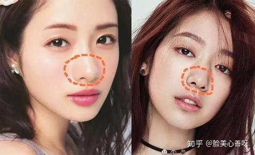 由于人种的差异,亚洲人最常见的鼻子问题就是肉鼻头,宽厚的鼻头与鼻翼