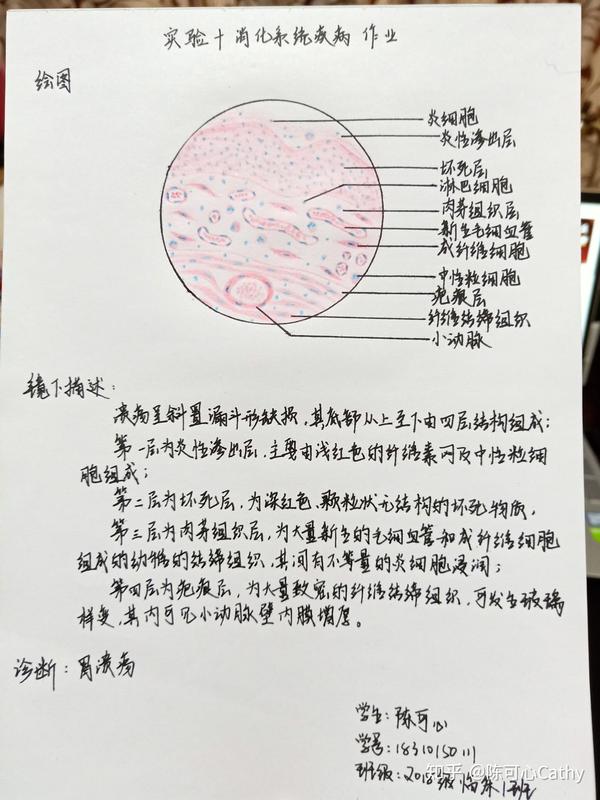 发完就清相册啦~ 有不妥的地方还希望大家指正  一,肝细胞水肿 最后