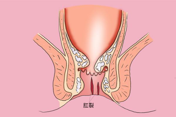 不要逃避治疗 肛裂反复感染易病变