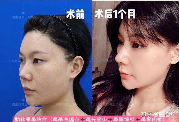 术前:鼻头大,鼻翼宽,鼻子较短,鼻骨较粗,鼻基底凹陷,气质显得疲惫