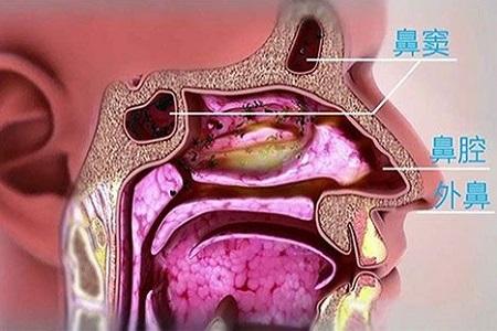 首大计成感冒鼻塞流鼻涕超过10天要考虑是否是鼻窦炎