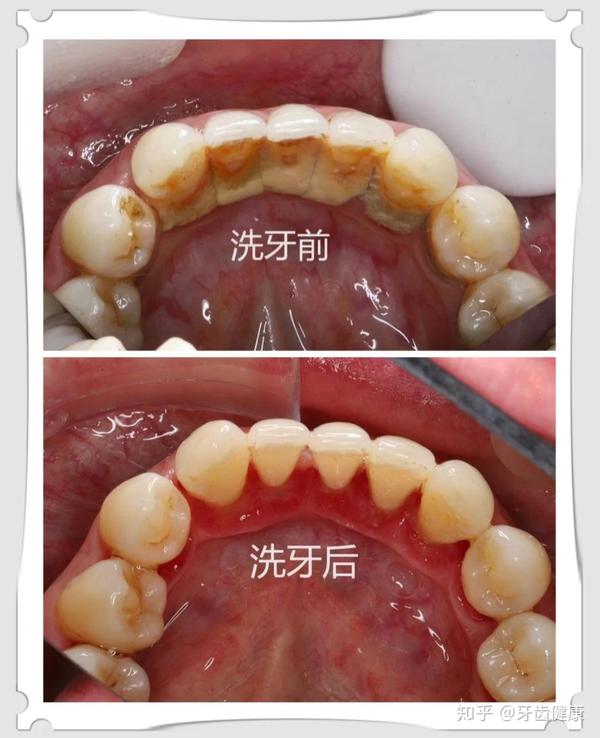 有时觉得刷完牙后牙齿确实变白了,那可能是因为美白牙膏中的着色颗粒