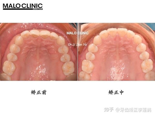 北京隐适美丨深覆盖,前牙内扣,要怎么矫正?