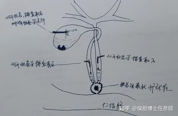 逐渐显露,完成了腹腔镜下胆管修补术,奥迪氏括约肌切开术,胆道的腹腔