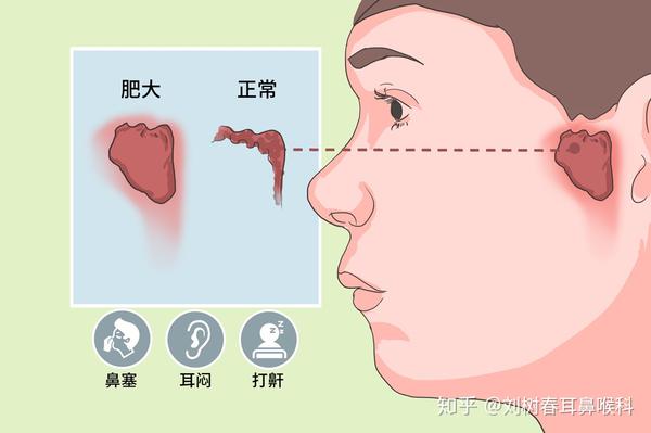 什么是腺样体肥大?腺样体肥大有哪些危害?