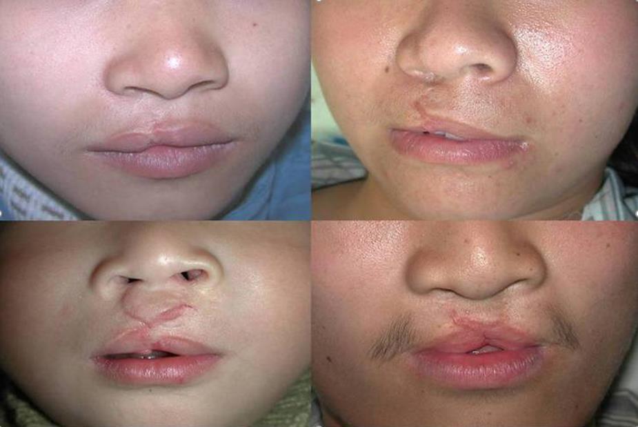 唇裂鼻子都会塌陷吗:唇裂术后鼻畸形修复问题