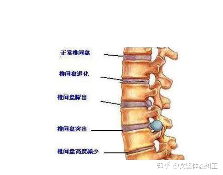 颈椎病头重眼花