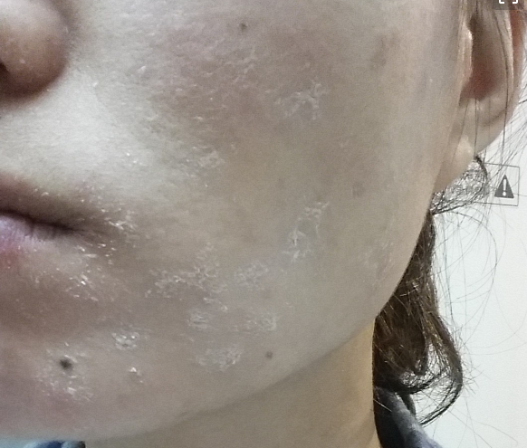 脸部皮肤干燥如何做好有效的保湿护理