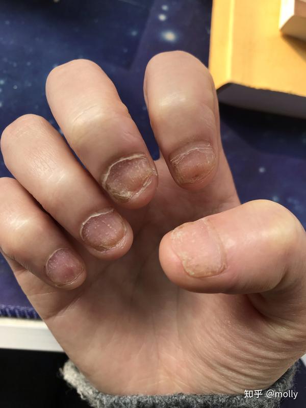 指甲银屑病的第八年