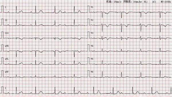 心电图图库丨高度三度房室传导阻滞系列