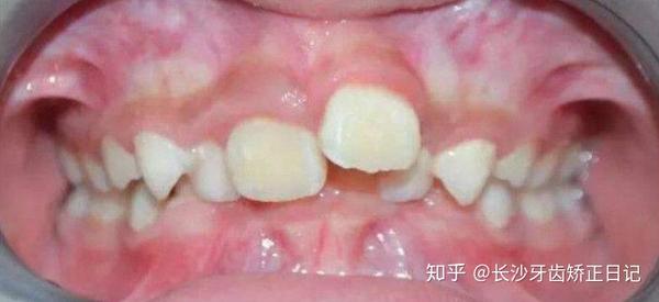 俗称"地包天",即下排牙齿包住上排牙齿.严重影响面容美