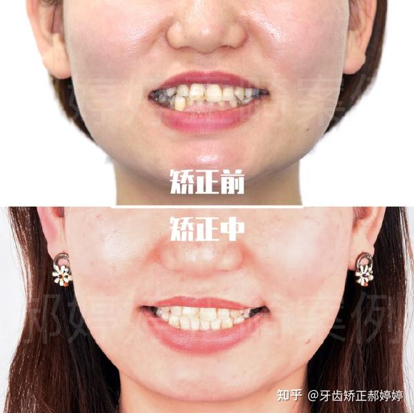 上海牙齿矫正牙齿的排列美矫正牙齿不齐案例