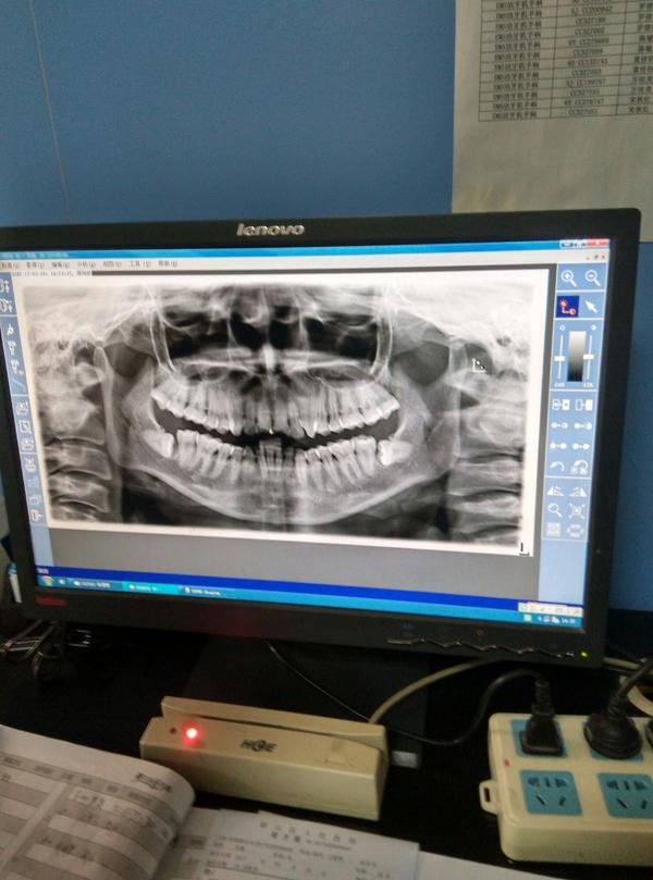 这两颗阻生齿都需要拔吗?已经照了cbct,一次拔一颗还是一起拔的好吗?