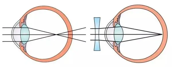 近视原理图