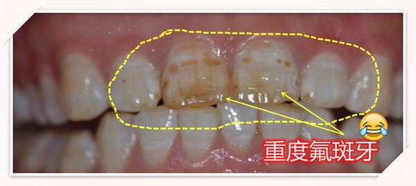 重庆牙齿修复:【门牙重度氟斑牙】 瓷贴面修复