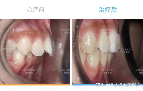 隐适美深覆合嘴突矫正案例