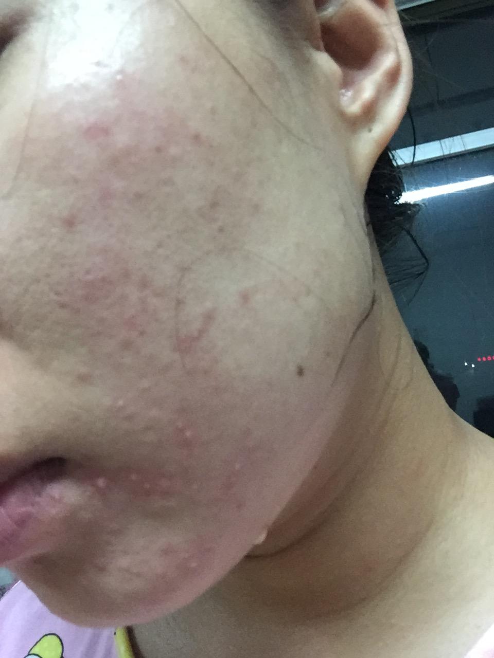 闭合性痘痘 脸上反复长闭合性粉刺 闭合性痘痘是什么样子的