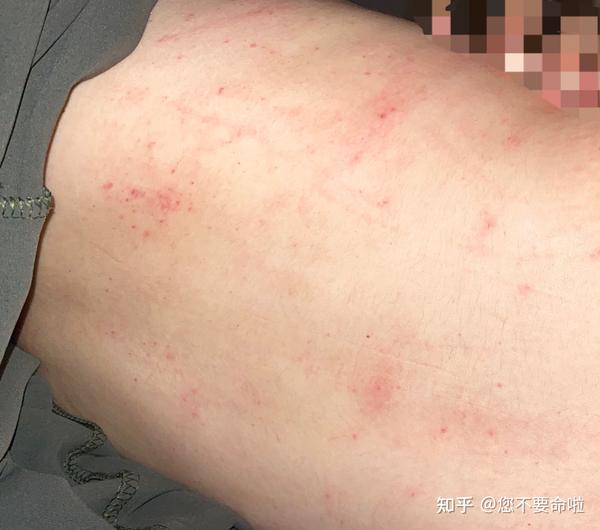 我这是被螨虫咬的吗