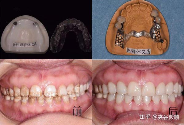 精密附着体义齿修复中的一次升级革新