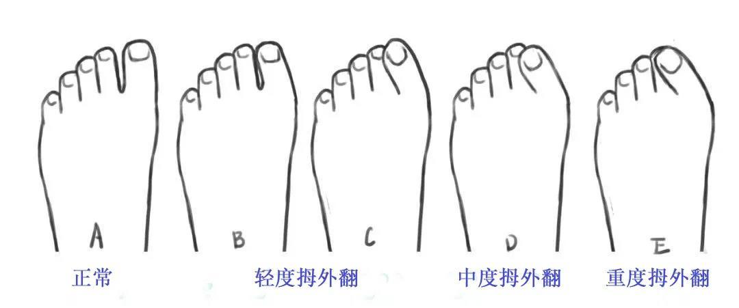 你的脚趾歪了带你了解拇指外翻