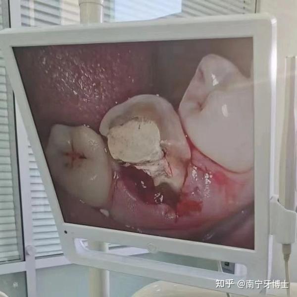 之前做了"根管治疗"后,没有及时做"牙冠",导致吃东西时把原来做过"根