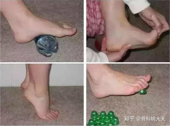 劳损性,扁平足等各种诱因,导致了足跟的疼痛,医学中被称为足跖筋膜炎