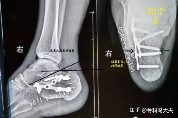 是一个正常的跟骨的一些解剖状态,它有一个正常的贝累氏角(bohler角)