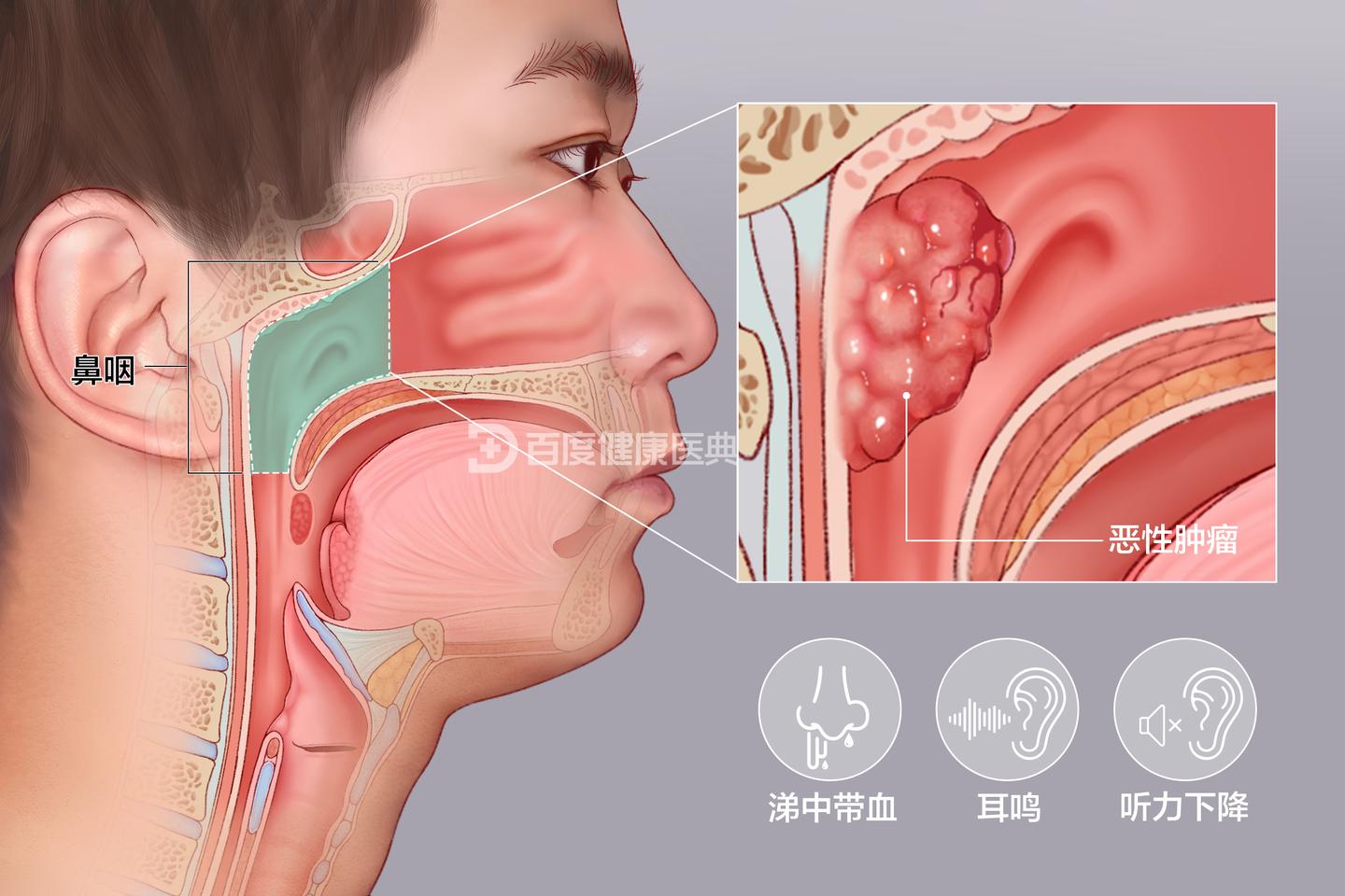 鼻咽癌的放射治疗