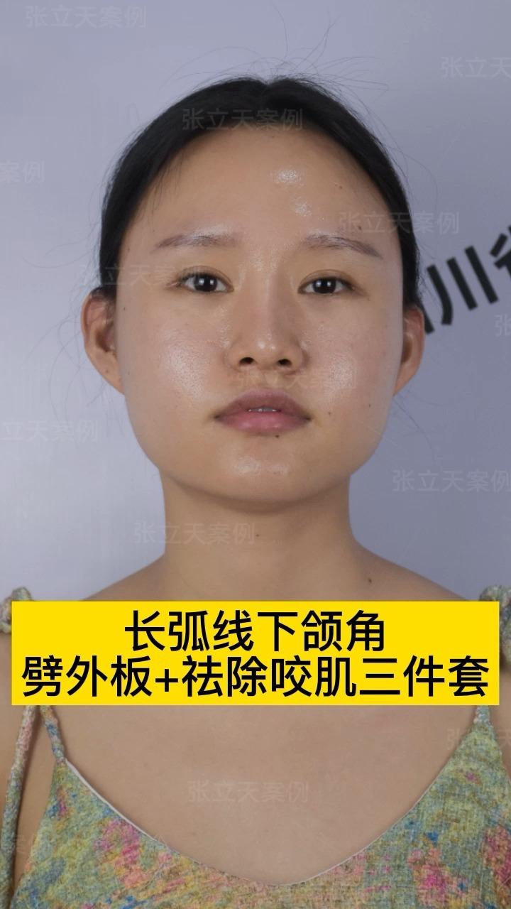 劈外板 祛部分咬肌,术后正面侧面都能有明显的改变,脸型逐渐蜕变成
