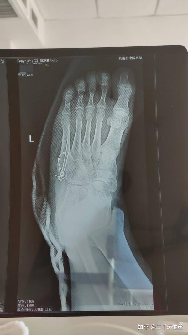 左足第五跖骨骨折手术恢复记录