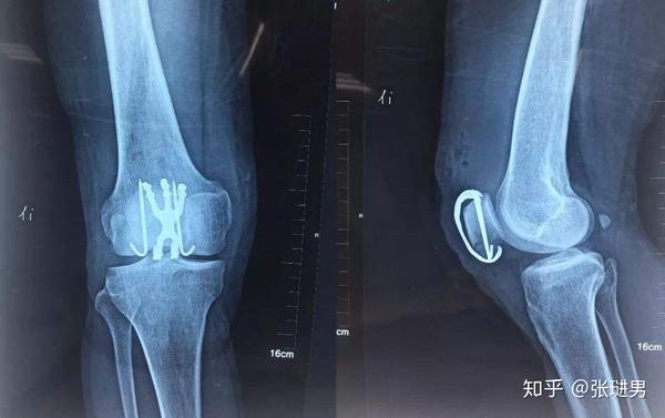 膝关节髌骨骨折康复指南天津艾柯特运动康复中心