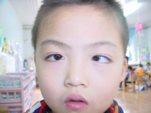 南昌眼视光: 如何预防儿童斜视的发生?