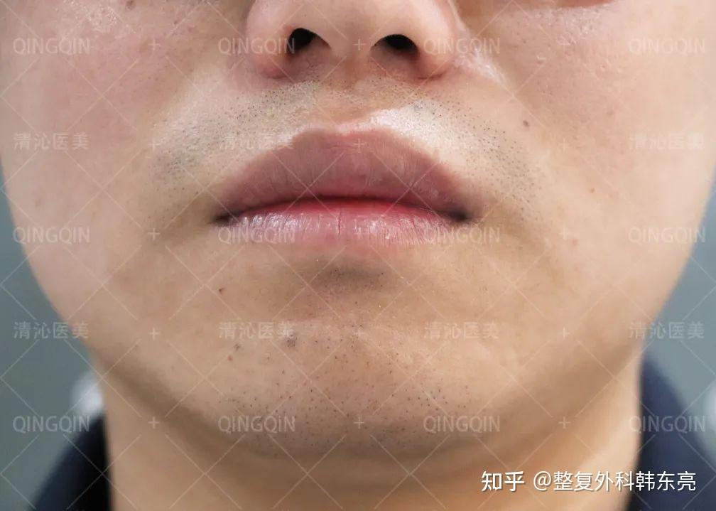 案例分享厚唇改薄从此告别香肠嘴