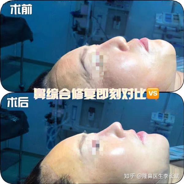 假体隆鼻取出后还能恢复到以前吗?