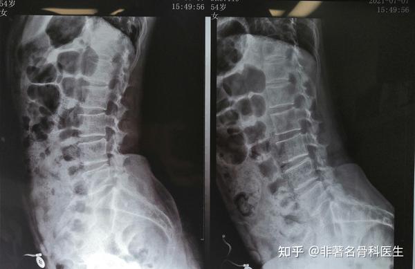 腰椎正侧位x光片我见骨质结构明显异常;腰椎动力位片未见明显不稳