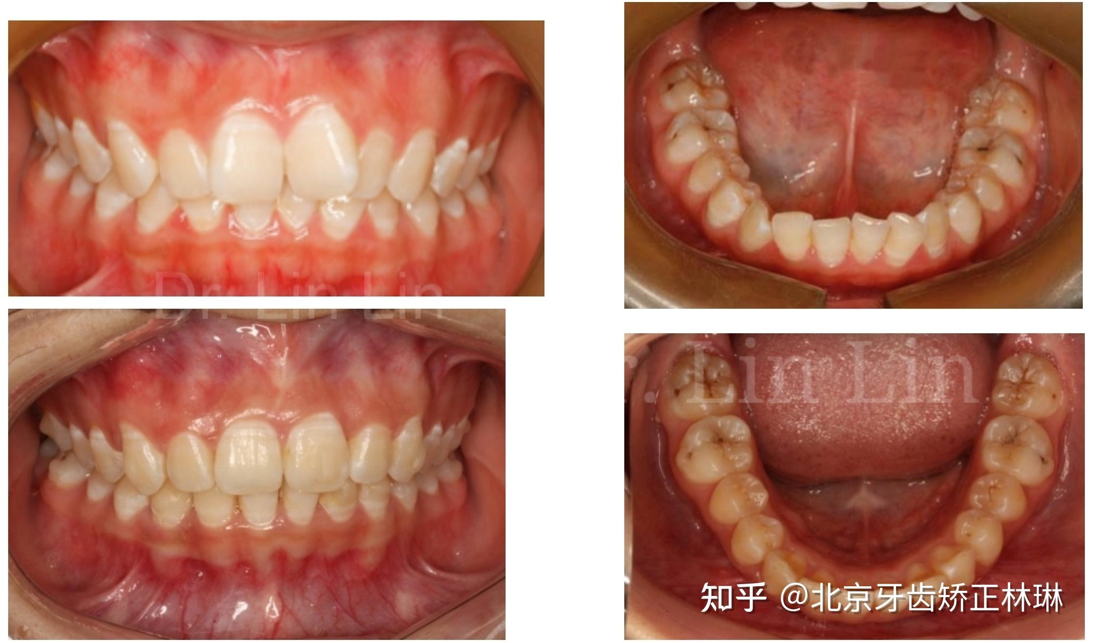 北京牙齿矫正林琳案例分享深覆合深覆盖牙齿前突牙齿拥挤